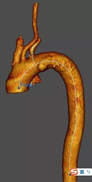 大动脉覆膜支架系统图片