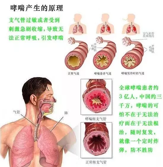 哮喘治疗不及时 会对身体造成哪些危害