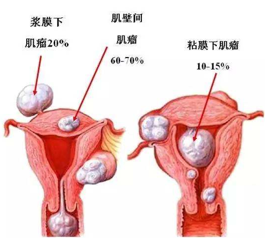 子宮肌瘤算是輕症疾病 子宮肌瘤保險中算輕症嗎