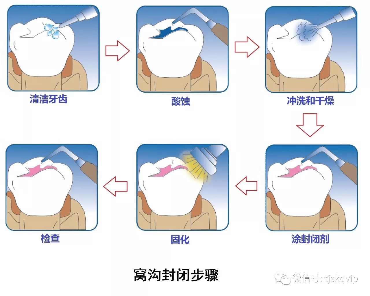 【口腔微学院】窝沟封闭,预防孩子蛀牙的必备"武器!