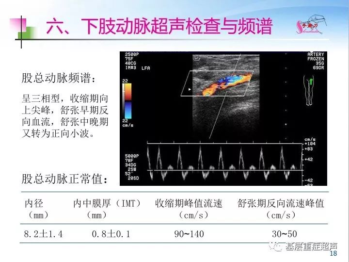 下肢血管的超声检查与正常声像图