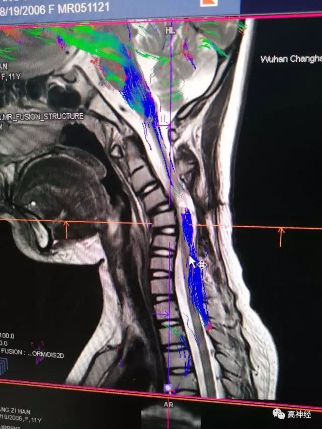 高清颈髓dti成像