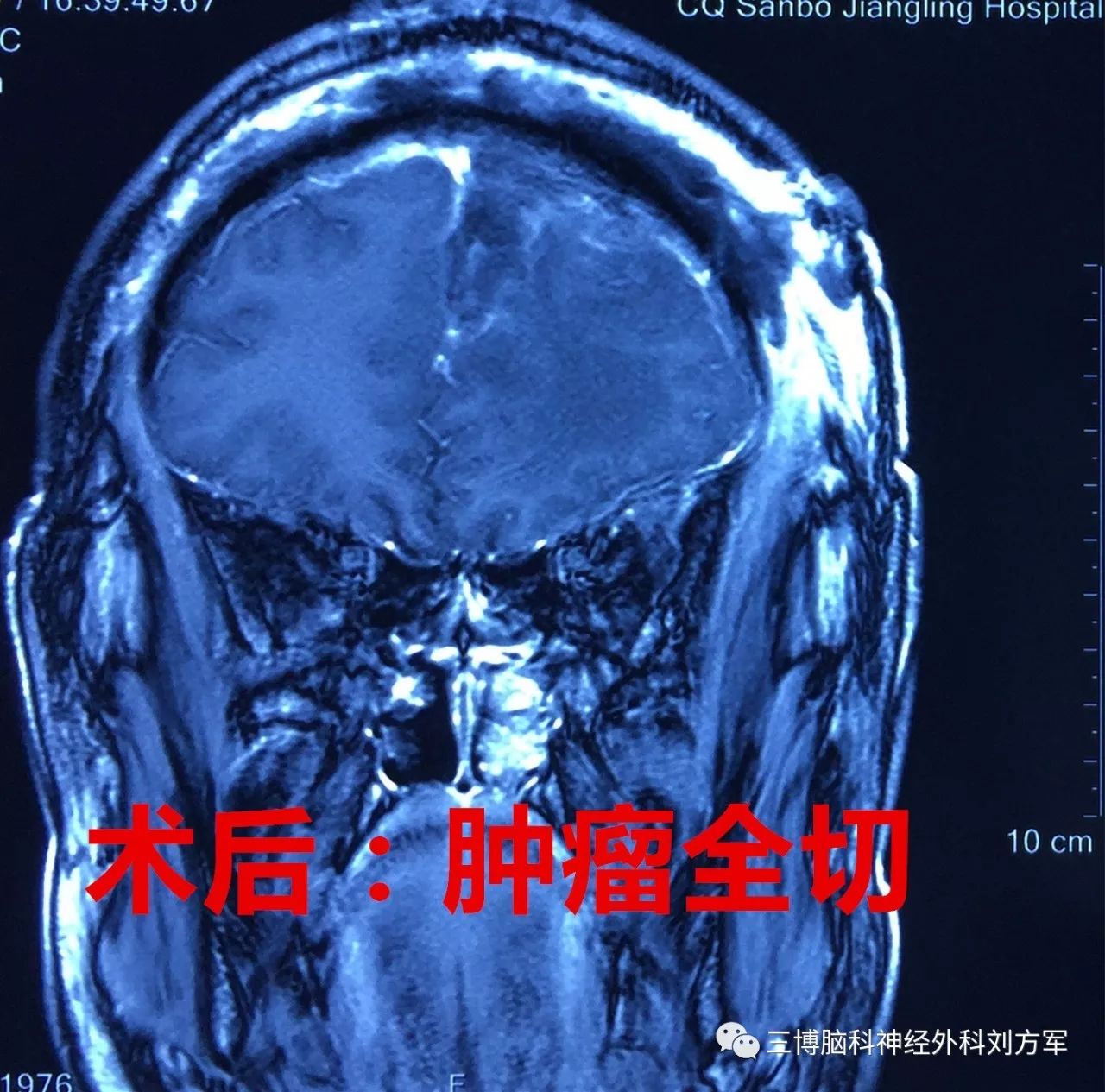 冠切左額開顱鐮旁腦膜瘤切除術圖片血腥飯前勿看