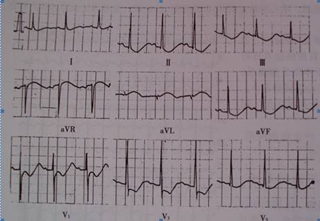 收藏丨一文讀懂非冠心病心電圖stt改變