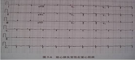 收藏丨一文讀懂非冠心病心電圖stt改變