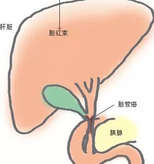 肝膽同源,膽經不通就會導致肝膽出現多種疾病,如膽囊炎,膽結石,脂肪肝