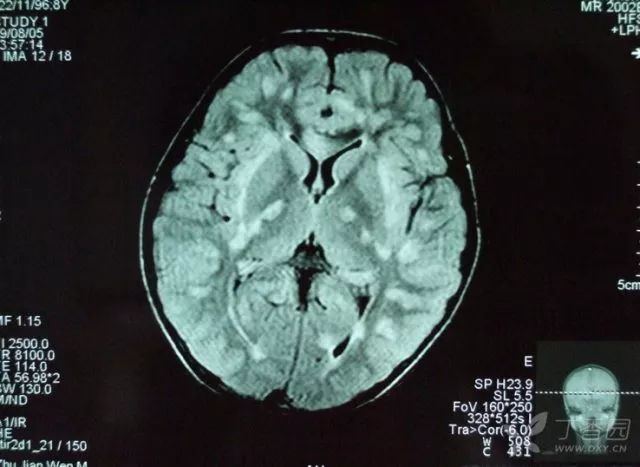 病毒性脑炎,这些影像学表现你都掌握了吗?