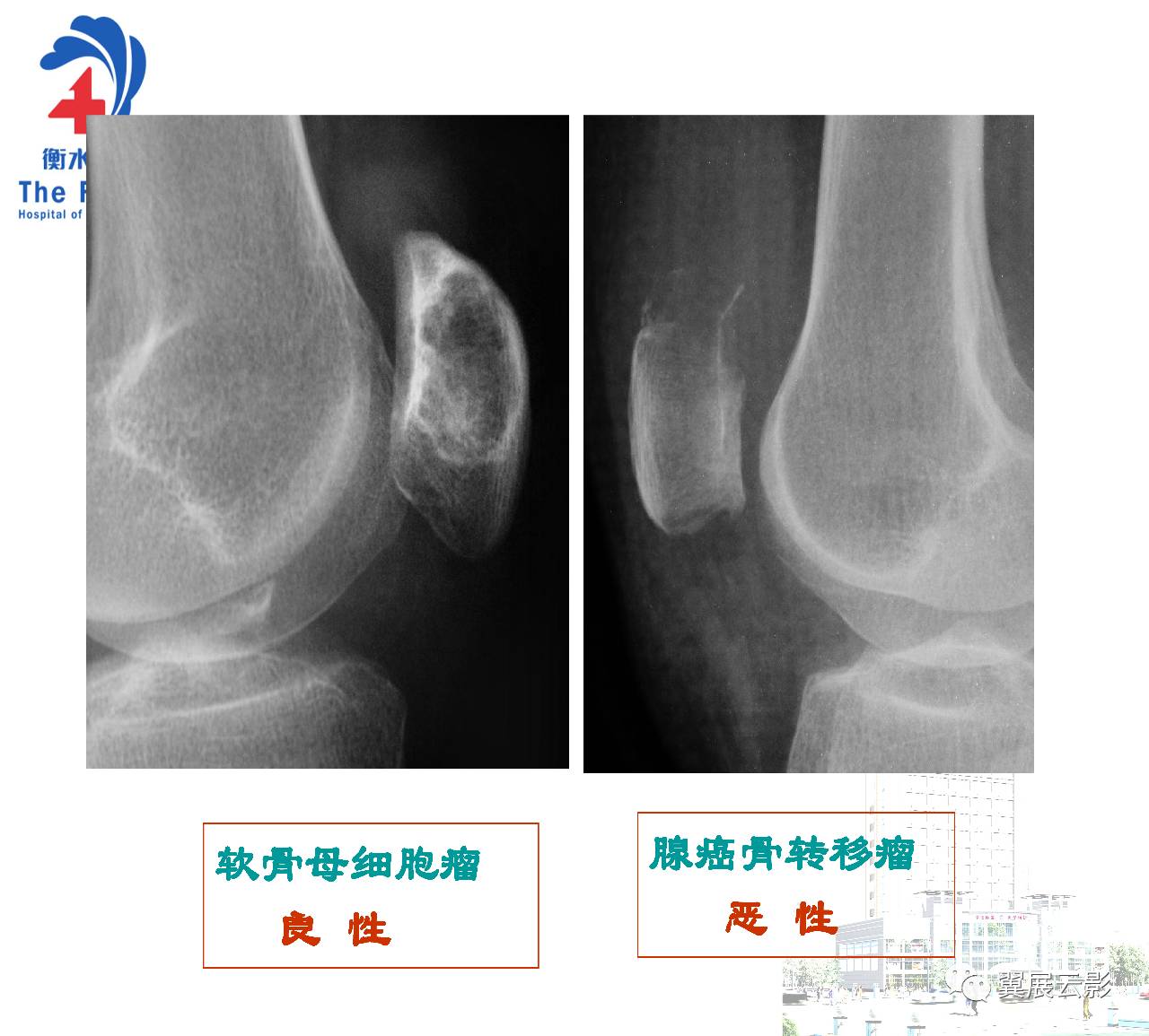 髌骨骨囊肿图片