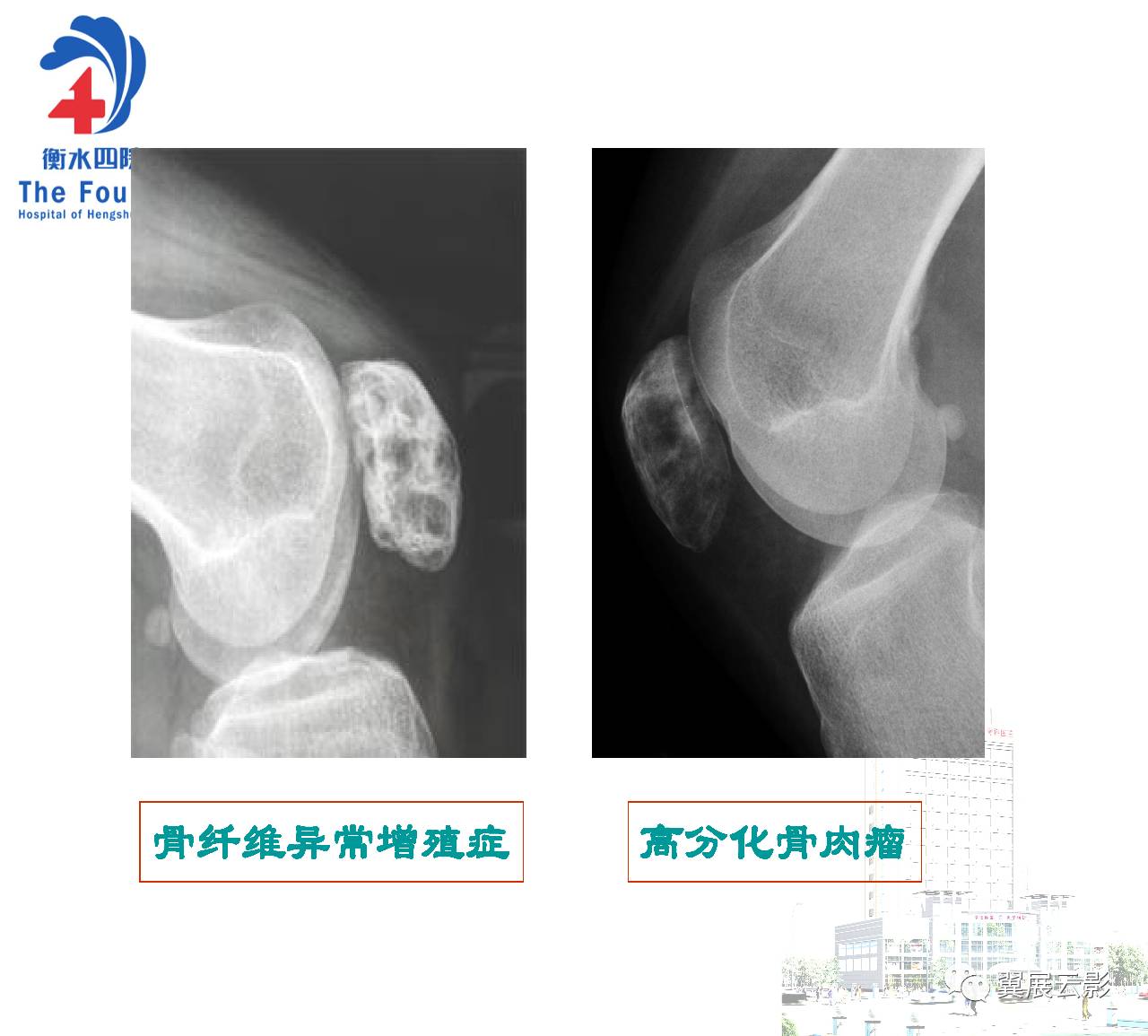 髌骨骨囊肿图片