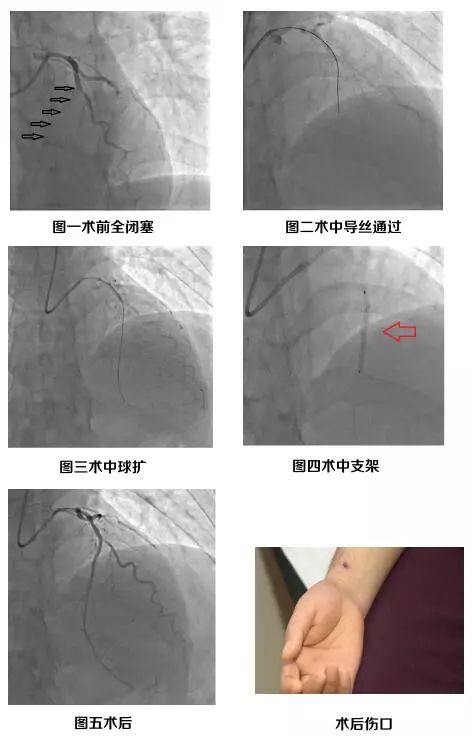 罹患重度冠脉病 北京上海寻医未果 来到远东 专家再次