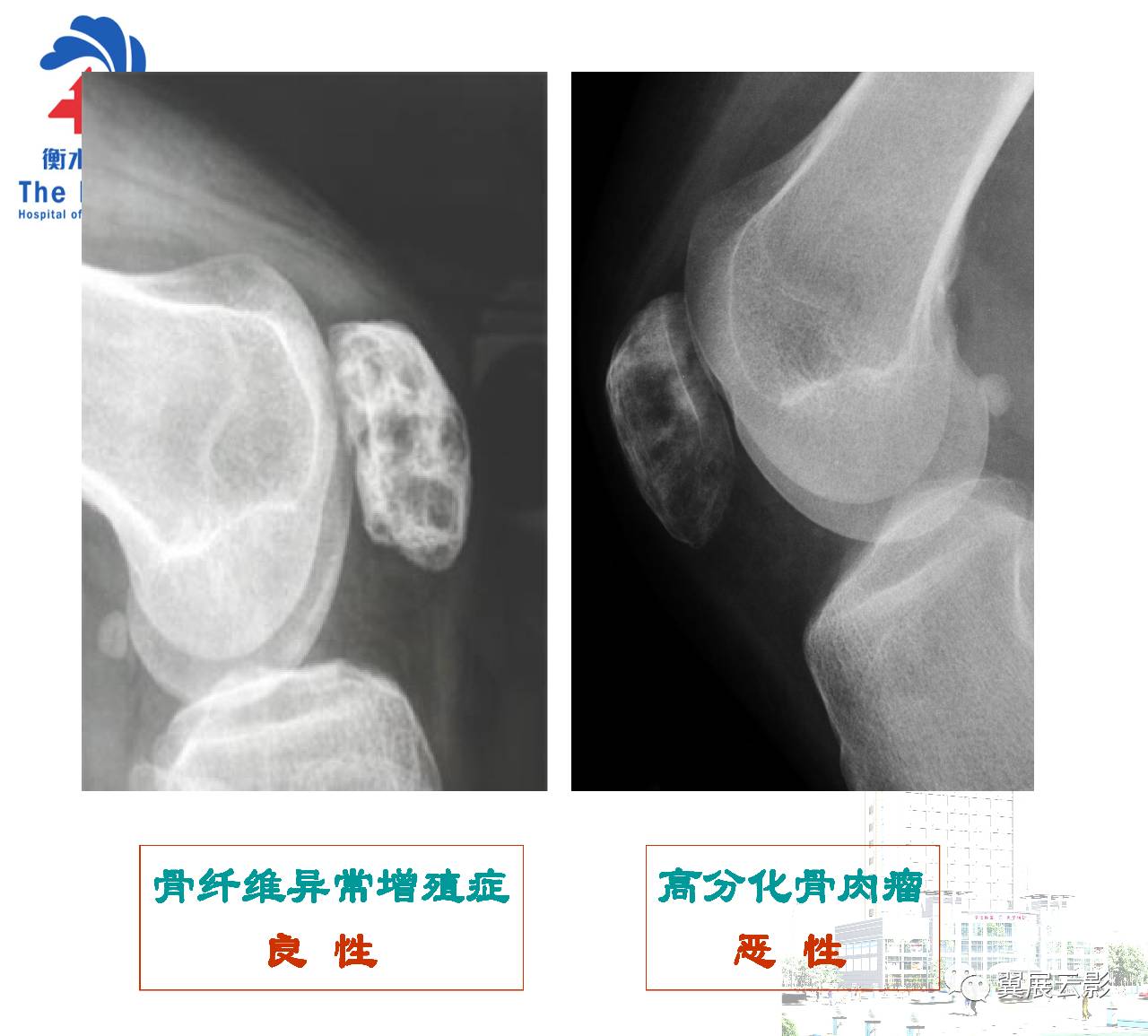 髕骨骨腫瘤及腫瘤樣病變分析