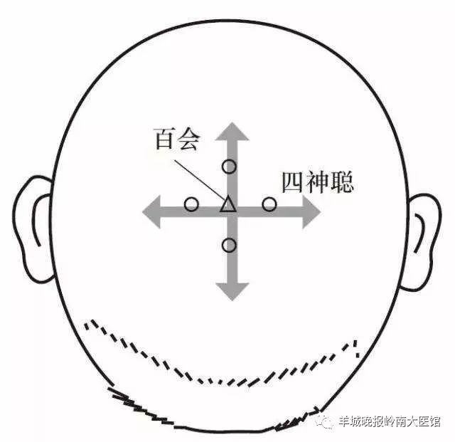 四神聪:位于头顶部,百会前,后,左,右各开1寸处.