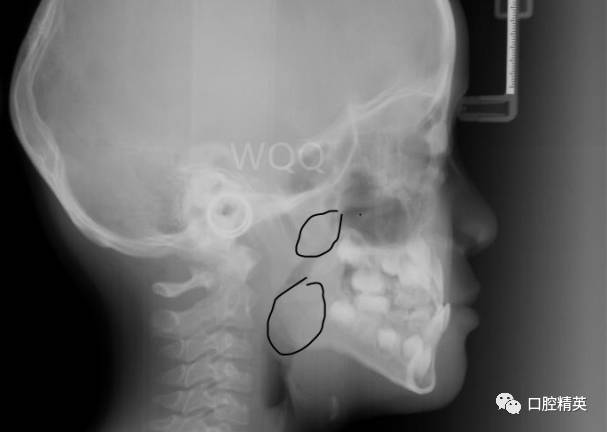 这是气道,显示通气量严重受影响侧位片显示:上下颌骨不调,但是尚可不