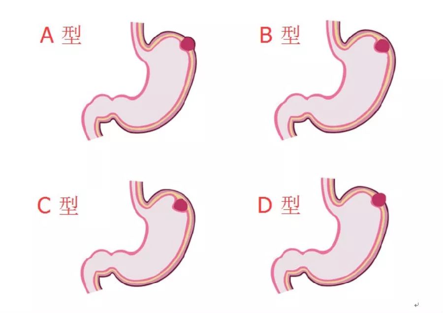 胃的四种形状图片图片