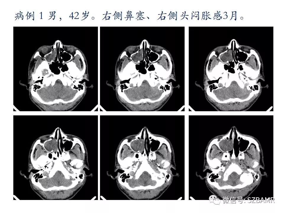 鼻腔鼻竇解剖及常見病變影像診斷一