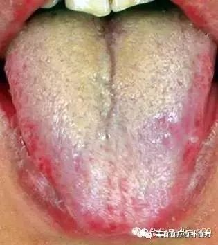 舌头有黑点是什么原因图片