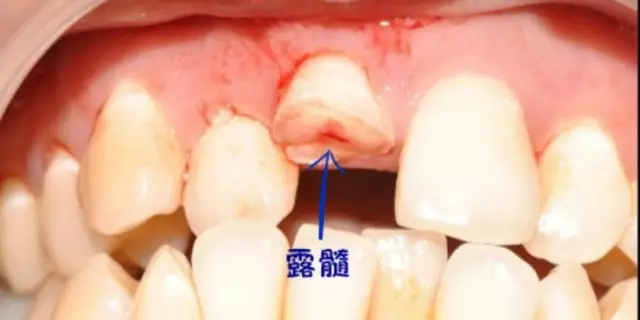 伤害可能导致牙齿松动或多或少受到外力伤害牙齿在磕掉的过程中诊断2