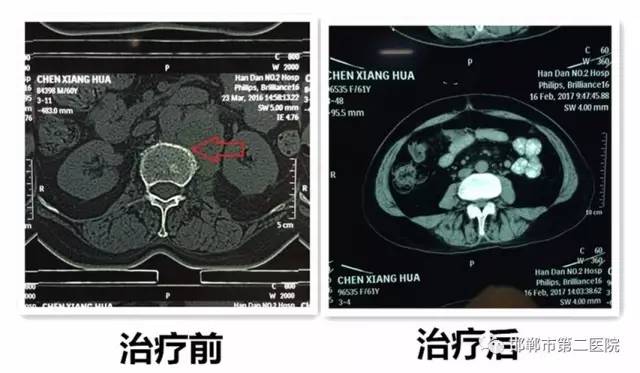 市二院內四科放化療聯合施治淋巴瘤浸骨致癱患者又重新站起來