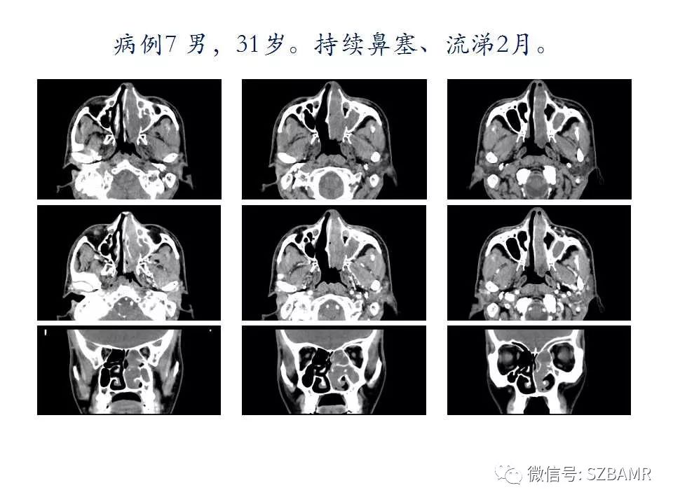 副鼻窦 瓦氏位图片