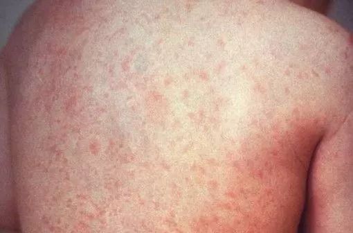 风疹:低热出疹由人类疱疹病毒6型导致发病率高达98
