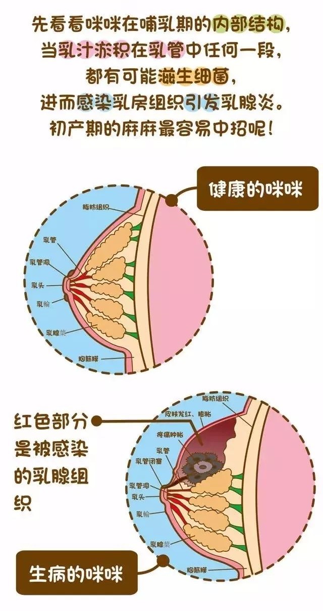 哺乳期间出现急性乳腺炎怎么办?