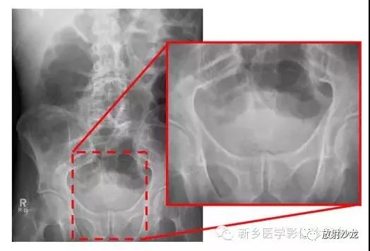 详细腹部平片解剖 正常表现 读片技巧 病例分析