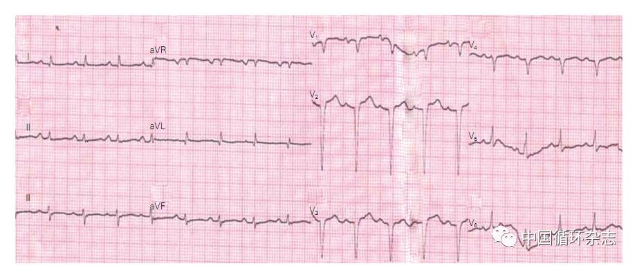 阜外醫院趙世華等研究稱,有這兩種心電圖特徵應懷疑心肌澱粉樣變