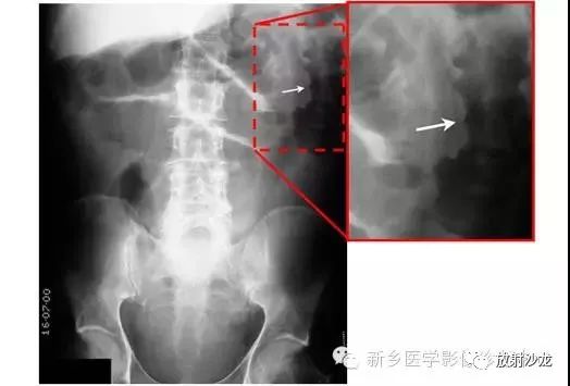 详细腹部平片解剖正常表现读片技巧病例分析