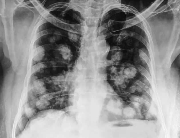 多学科会诊综述影响治疗肺癌策略的肺转移及多发性肺癌研究进展