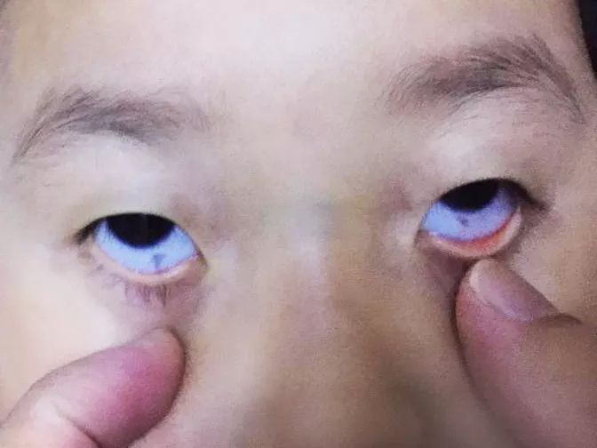 专家在线丨宝宝眼珠上长斑会影响视力吗?