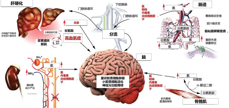 帶你讀懂 | 肝性腦病的發病機制與分類