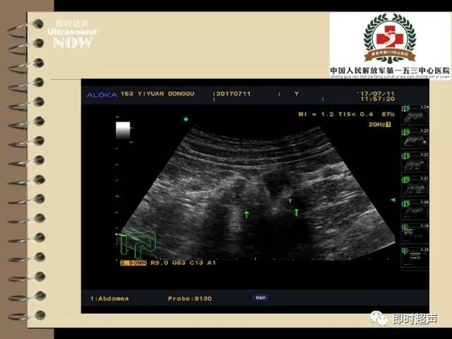 右側結腸憩室超聲診斷分析