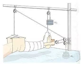 小儿股骨骨折牵引图片图片