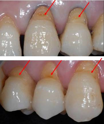 根尖周炎治療方法:根管治療(rct)(五)牙齦炎病因:牙結石表現:牙齦紅腫