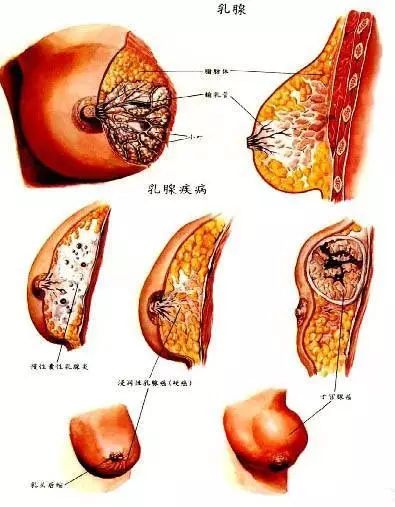 乳腺乳头状瘤图片