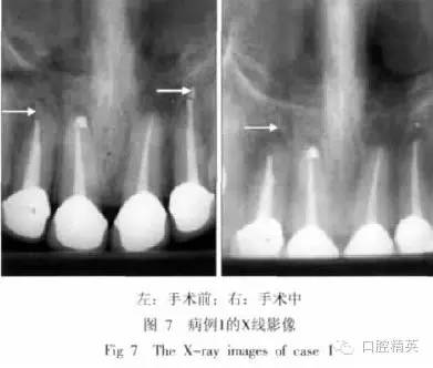 x线牙片在牙齿疑难病例诊断中的参考价值