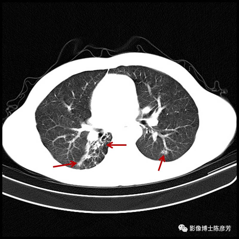 肺部纤维条索影的原因是什么？