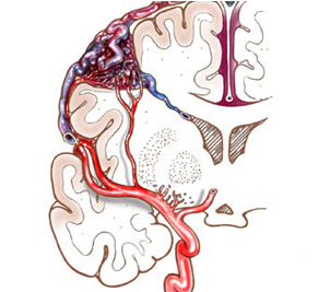 病死率为10,脑动静脉畸形什么情况下更容易破裂出血?