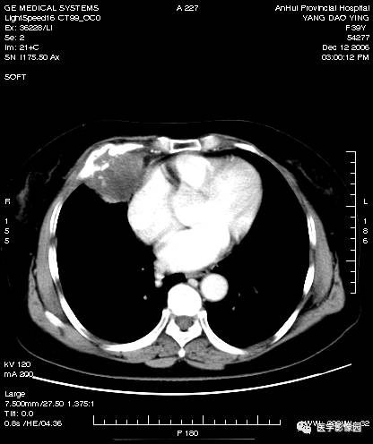 第八章骨骼與軟組織第二節骨腫瘤三惡性腫瘤三軟骨肉瘤丨精品連載