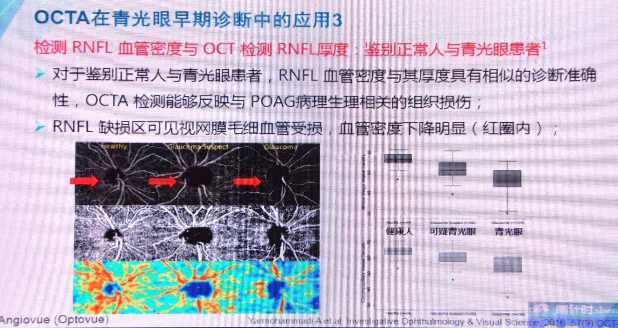octa青光眼全程監控的一大利器