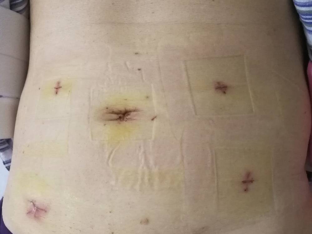腹腔镜疤痕图片