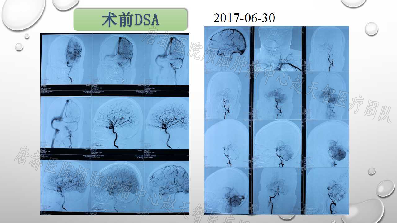 頭顱核磁共振(mri),ct,dti,cta,dsa等檢查