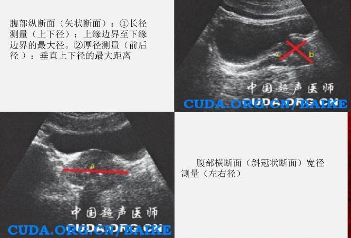 前列腺超声检查三问