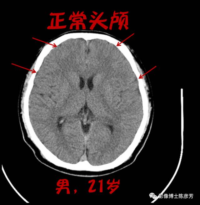 脑萎缩正常图片