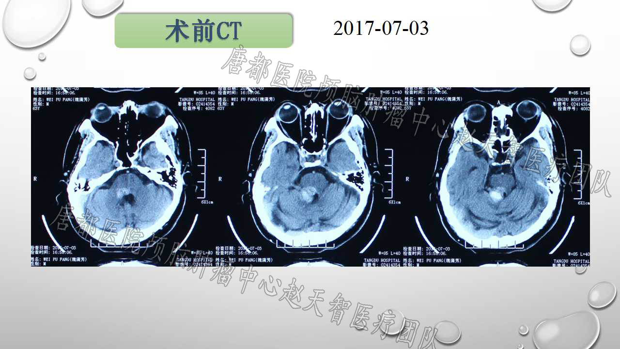 魏先生6月26日入院進一步完善影像學檢查,頭顱核磁共振(mri),ct,dti