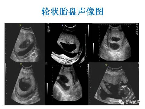 图五(图四(图三(图二(图一)图片展示6,双胞胎之一死亡后残留羊膜5