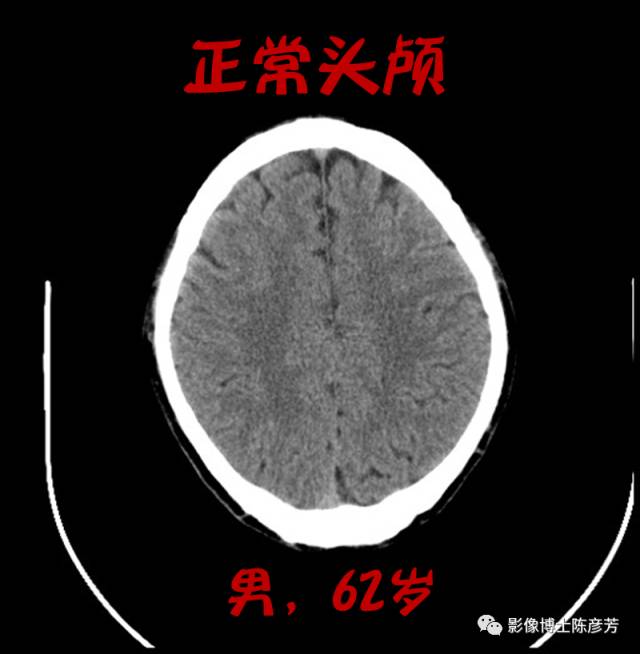 脑萎缩ct图片解说图图片