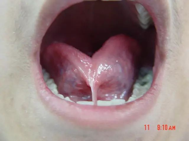 正常人的舌系带图片