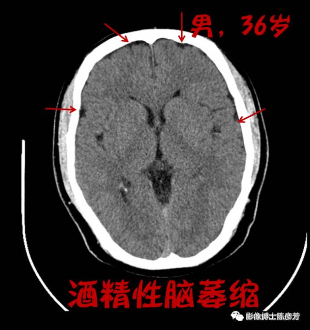 下脑室平面图脑沟明显增多,增宽,和颅骨之间已经出现缝隙