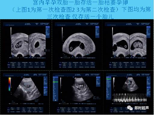 分離,卵黃管回聲(在早期妊娠值妊娠9-16周的正常表現)4,羊膜帶綜合徵